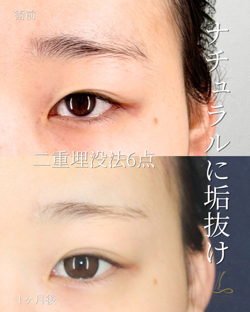 埋没法の症例写真