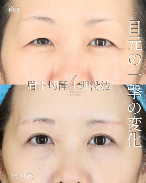 眉下切開＋埋没法の症例写真
