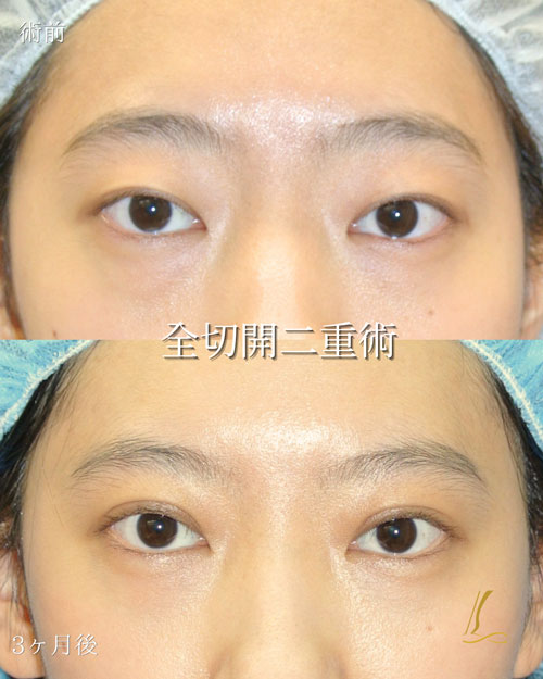 全切開二重術（二重切開法）の症例写真