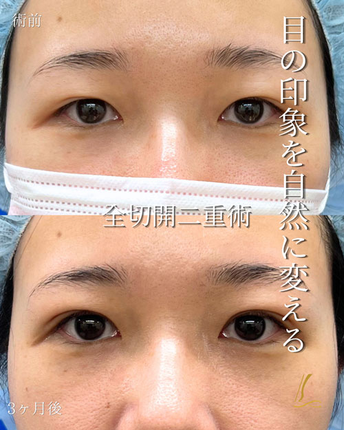 全切開二重術(二重切開法)の症例写真