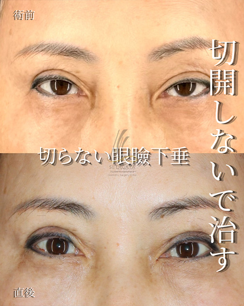 眼瞼下垂症手術