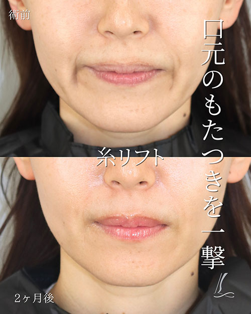 糸リフトの症例写真