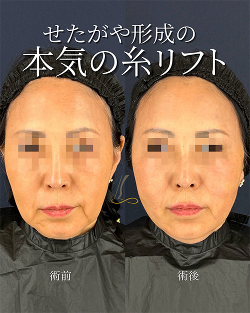 糸リフトの症例写真