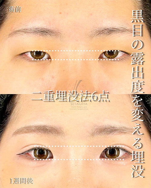 埋没法の症例写真